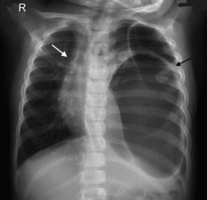 Figure. Chest radiograph of a 4-year-old-girl who presented with abdominal pain after minor trauma, showing a large, gas-filled structure in the left hemithorax (black arrow) and mediastinal shift (white arrow) and poor definition of the left diaphragm.