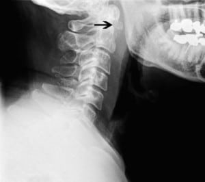 Figure 1. Plain radiographs, though less sensitive than computed tomography, are an acceptable screening examination. A calcific focus is visible just anterior to C1.