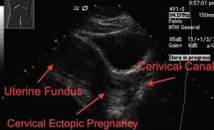 Figure 1. Transabdominal ultrasound in longitudinal plane.