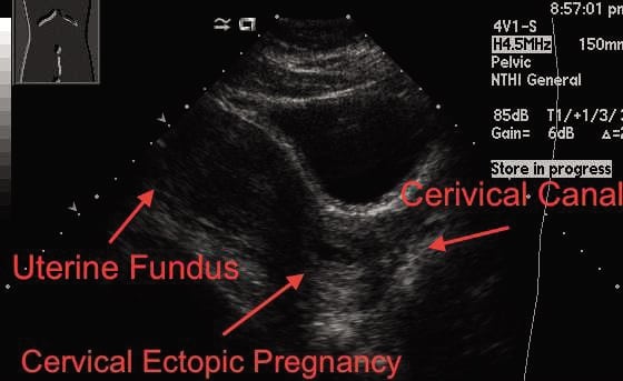 Cervical Ectopic Pregnancy