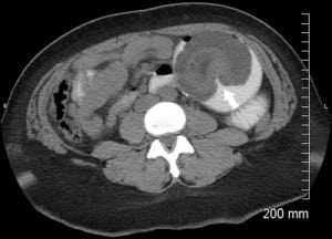 Figure. Computed tomography with oral and intravenous contrast showing the pathognomonic “target sign” (white arrow).