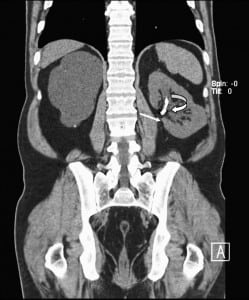 Figure 1. Coronal computed tomography in soft tissue window. Left ureteral stent (curved arrow) and eroded embolization coil (straight arrow) are noted within the left renal pelvis. On this window setting, these are difficult to tell apart.