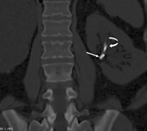 Figure 2. Importance of appropriate window levels and window widths on computed tomography. Bone windows clearly differentiate the ureteral stent (curved arrow) from the embolization coil showing surface detail (white arrow).