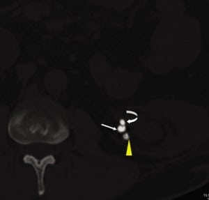 Figure 3. Axial computed tomography computed tomography (CT) in bone window: importance of appropriate window levels and window widths on CT. Bone windows clearly differentiate the ureteral stent (curved arrow) from the embolization coil (white arrow) and stone forming due to coil acting as nidus (yellow arrowhead).
