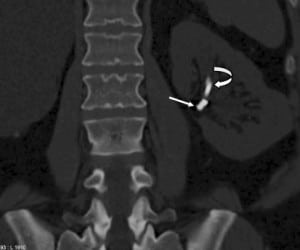 Figure 4. Coronal and curved coronal reformatted image showing different attenuation and appearance of the left ureteral stent (curved arrow) and eroded embolization coil (straight arrow).