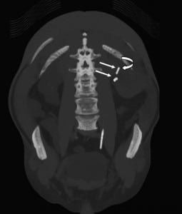 Figure 5. Coronal and curved coronal reformatted image showing different attenuation and appearance of the left ureteral stent (curved arrow) and eroded embolization coil (straight arrow).