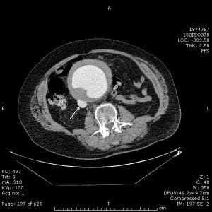 Figure 1. Computed tomography of the abdomen with contrast opacification of the inferior vena cava suggesting an aortocaval fistula.