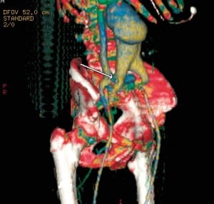 Figure 2. Reconstruction imaging showing fistula between iliac artery and vein.