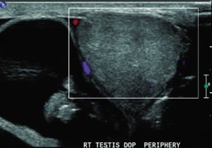 Figure. Ultrasonogram demonstrating no blood flow to the right testicle owing to the adjacent bowel within the scrotum.