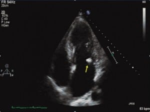 Figure 2. The vegetation on the mitral valve leaflet (arrow).