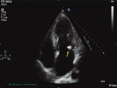 Recognizing Infective Endocarditis in the Emergency Department - The ...