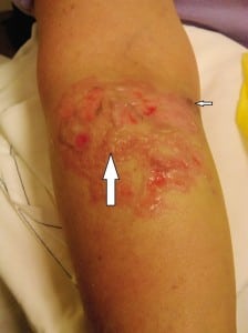 Figure. Second-degree burn of the right upper extremity. The photograph shows unroofed blisters (large arrow) with ecchymosis on the medial aspect (small arrow) of the antecubital fossa after propofol extravasation.