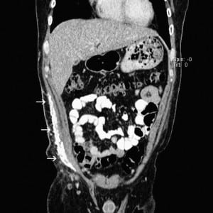Figure 1. Coronal view of computed tomography showing extensive calcification of right flank.
