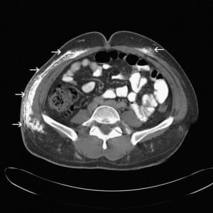 Figure 2. Sagittal view of computed tomography showing right-sided calcification as well as small calcific foci on left anterior abdomen.