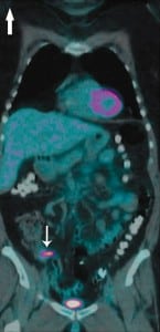 Figure 1. Positron emission tomography performed 10 days prior to presentation showing fludeoxyglucose uptake in the proximal appendix without surrounding inflammation consistent with appendiceal metastasis (arrow).
