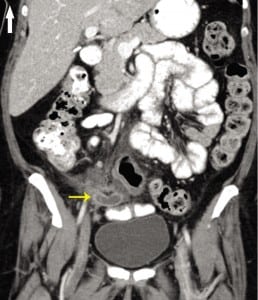Figure 2. Contrast-enhanced abdominal computed tomography of the abdomen performed in the emergency department showing a dilated appendix with enhancing wall and surrounding fat stranding (arrow) suggestive of acute appendicitis.