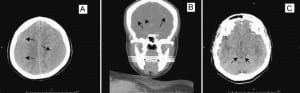 Figure. Computed tomography (CT) of the head showing bilateral subacute hematomas at the convexity of both hemispheres with ventricle compression. A, Transverse CT of the head with bilateral subdural hematoma (arrows). B, Axial CT of the head demonstrating bilateral subdural hematomas (big arrows) and compression of the ventricle (arrowhead). C, The diminishing of the basal cisterns next to the brain stem indicates the increased intracranial pressure and downward displacement of the brain caudally (arrows).