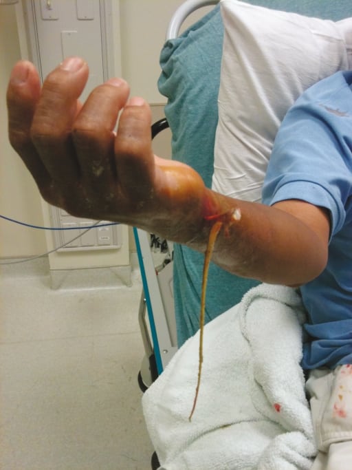 A Pain in the Wrist: Stingray Envenomation