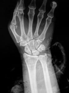 Figure 2. Radiograph of hand.