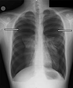 Figure 1. Postero-anterior radiograph of the chest shows near complete bilateral pneumothorax without evidence of pneumomediastinum, pneumopericardium, or subcutaneous emphysema.