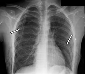 Figure 2. Postero-anterior radiograph of the chest shows interval placement of bilateral chest thoracostomy tubes with complete re-expansion of the left lung and partial (∼70%) re-expansion of the right.