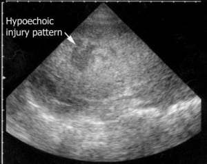 Figure 1. Ultrasound image of a solid organ injury seen as a hypoechoic region within the parenchyma.