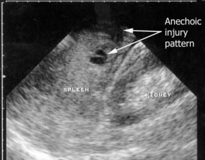 Figure 2. Ultrasound image demonstrating disruption of the splenic architecture representing solid organ injury.