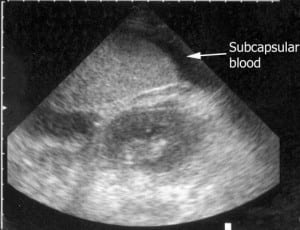 Figure 3. Ultrasound image of splenic subcapsular fluid.