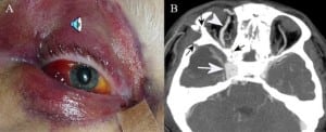 A. Periorbital hematoma, complete ophthalmoplegia and loss of pupillary light reflex. Audible bruit over the eyeball (audio). B. Head CT scan with enlarged right cavernous sinus. Click on image for periorbital noise audio (http://repositories.cdlib.org/cgi/viewcontent.cgi?filename=0&article=1291&context=uciem/westjem&type=additional).