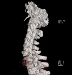 Figure 1. 3D Maximal Intensity Projection (MIP) CT Image of the bilateral dislocated facets (locked facets), C-6 on C-7.