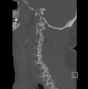 Figure 2. Computer tomography of the bilateral dislocated facets (locked facets). A sagittal reconstruction of the cervical spine demonstrating C-6 dislocated over C-7.