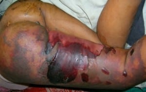 Figure. Extensive areas of purpura, ecchymosis and skin necrosis with hemorrhagic blebs and disrupted bullae, involving the left lower extremity.