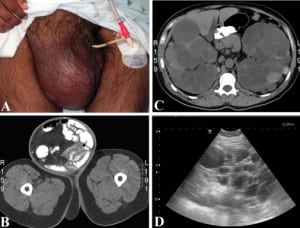 Figure. A, Gross appearance of inguinal hernia. B, computed tomography showing large inguinal hernia containing small bowel and cecum with intraluminal contrast. C, appearance of bilaterally-enlarged kidneys with innumerable cysts. D, emergency department ultrasound image of the right upper quadrant showing multiple cystic structures.