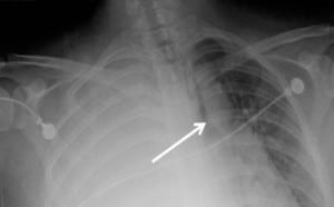 Figure 1. Portable chest radiograph reveals a right pyothorax with a mediastinum that is drastically shifted to the left.