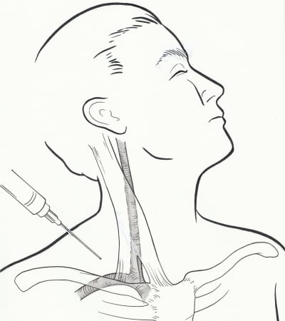 Supraclavicular Subclavian Vein Catheterization: The Forgotten Central Line