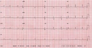 Figure 1. 12-lead ECG from a 54-year-old male with syncope and hypotension.