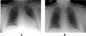 Figure 2. Portable chest radiograph from a 54-year-old male with syncope and hypotension (panel A), compared to a portable chest radiograph obtained from the same patient four months earlier (panel B).