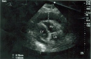 Figure 3. Portable cardiac ultrasound from a 54-year-old male with syncope and hypotension, obtained during early systole. LV = left ventricle, RV = right ventricle, LA = left atrium. Echo-free space (effusion) 37 mm (vertical dashed line).