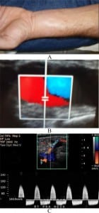 Figure 1. A) Pulsatile swelling on right distal wrist, B) Color doppler view showing classic “yin-yang” pattern of turbulent blood flow of a pseudoaneurysm and C) “To-and-fro” spectral waveform of a pseudoaneurysm neck not depicted in our study.