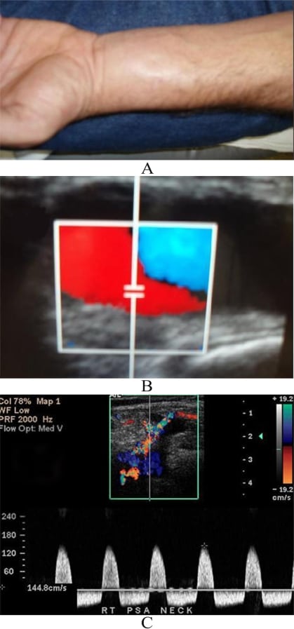 form health school for Diagnosed Artery by of Pseudoaneurysm Bedside the Radial