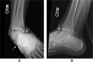 Figure 2. Anteroposterior (panel A) and lateral (panel B) radiographs of the right ankle from a 26-year-old male, demonstrating a medial subtalar dislocation.