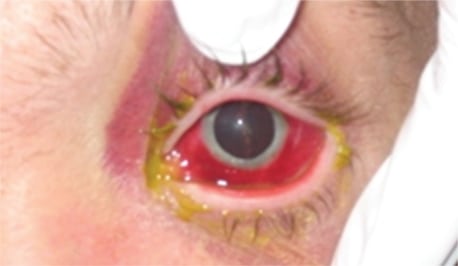 Painful Red Eye