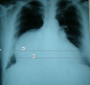 Figure 1a. Posteroanterior chest radiogram showing increased cardiothoracic ratio (brackets). The cardiac diameter (a) is 70% of the transthoracic diameter (b).