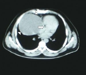Figure 1b. Contrast-enhanced computed tomography showing a large cystic mass (arrowheads)causing cardiac compression (arrows).