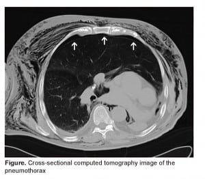 Figure. Cross-sectional computed tomography image of the pneumothorax