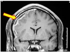 Figure. Magnetic resonance imaging revealing a right subdural empyema with meningeal enhancement.