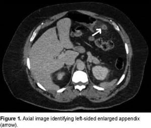 Figure 1. Axial image identifying left-sided enlarged appendix (arrow).