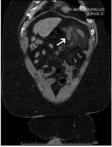 Figure 2. Coronal image identifying left upper quadrant acute appendicitis (arrow).
