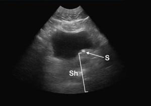 Figure 1 Emergency department ultrasound (EDUS). Direct stone visualization (S) with shadowing (Sh) and protrusion of the left posterior bladder wall.