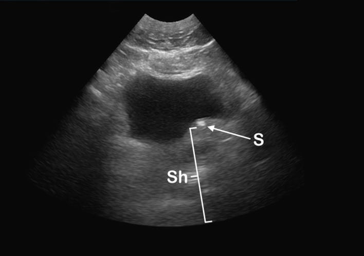 Bladder Bulge: Unifying Old and New Sonographic Bladder Wall Abnormalities in Ureterolithiasis